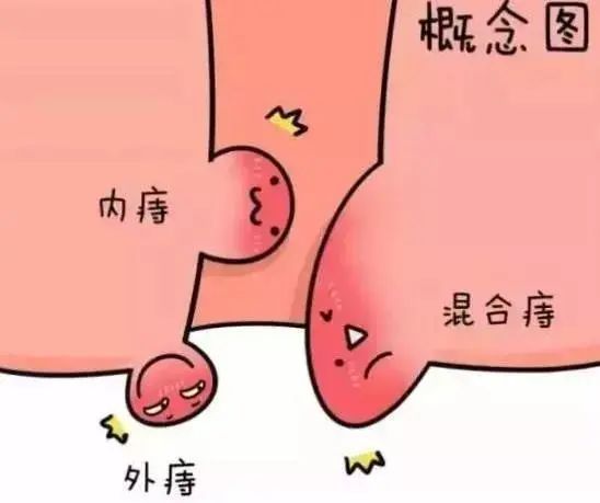 【拉升標(biāo)桿跑起來(lái)】?jī)?nèi)痔出血15分鐘輕松治療——消化內(nèi)科熟練開展透明帽輔助內(nèi)鏡下硬化治療術(shù)