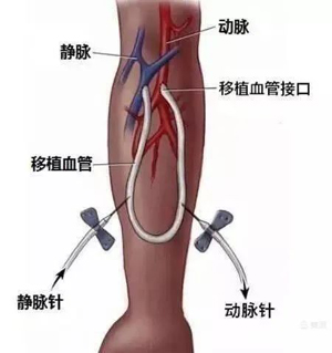 多一種選擇，便多一線生機(jī)——腎內(nèi)科首例人工血管內(nèi)瘺術(shù)成功實(shí)施
